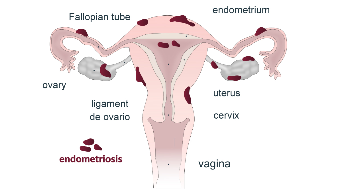 endometriosis endometriosis