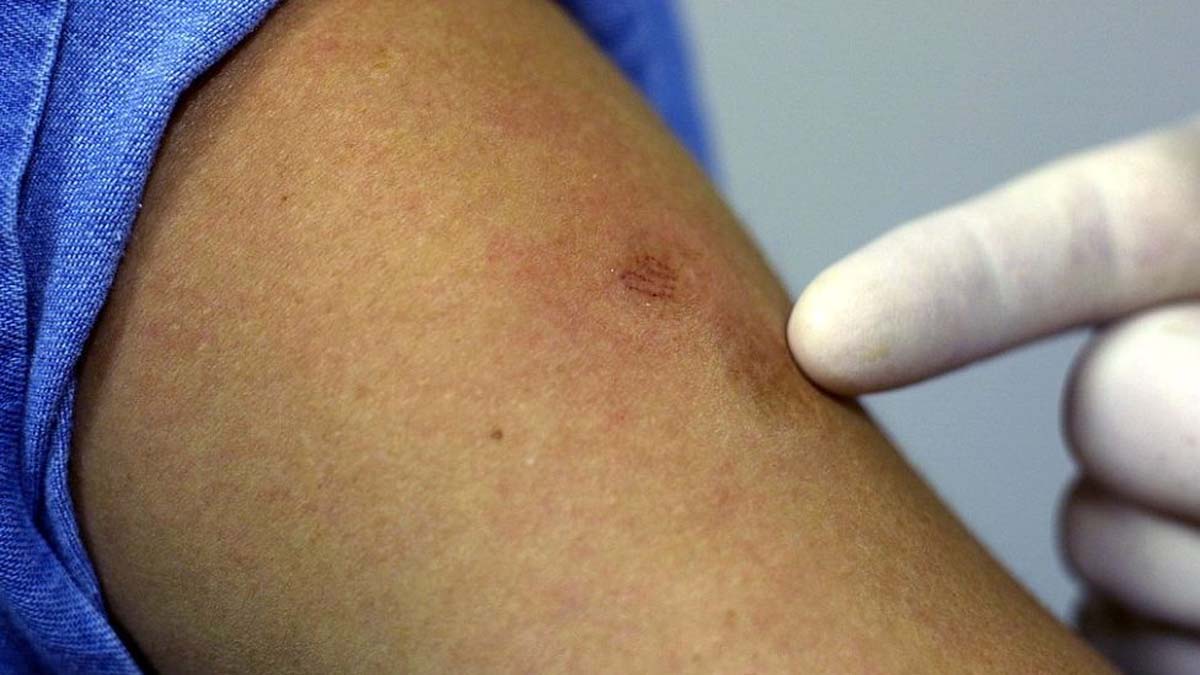 Inquietud ante el aumento de casos de 'Viruela del mono'