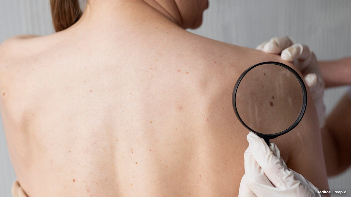 Cáncer de piel Cáncer de piel