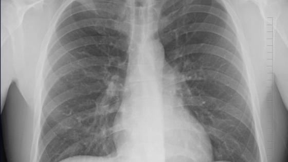 pulmones pulmones