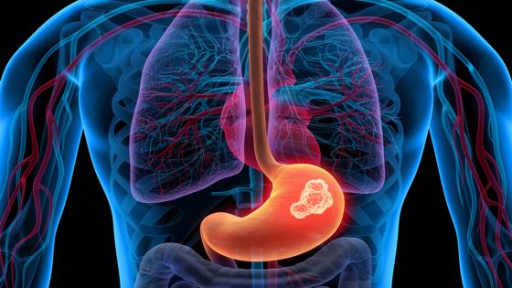 cáncer de estómago y esófago cáncer de estómago y esófago