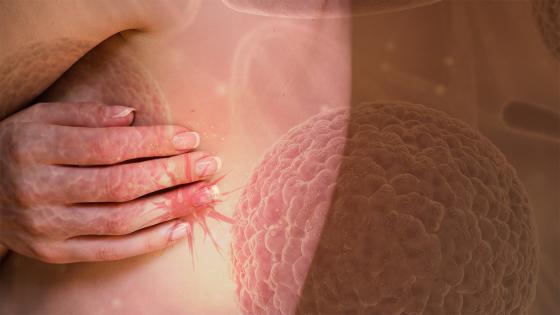 Cáncer de piel Cáncer de piel