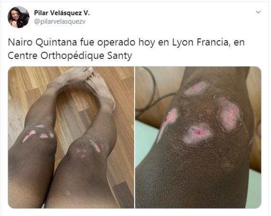 Rodillas de Nairo Quintana Rodillas de Nairo Quintana