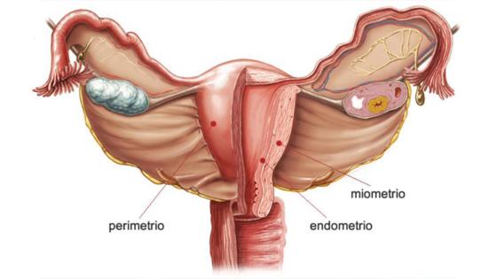 endometrio endometrio