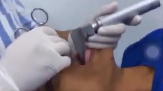 Médicos sacan un pescado de la garganta de un pescador Médicos sacan un pescado de la garganta de un pescador