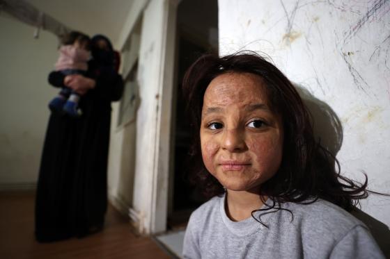 Latife al Alyan (der.), una niña siria de 6 años que sufrió quemaduras en la cara durante un ataque aéreo de las fuerzas del régimen de Bashar al Asad en Idlib en 2019 y luego se refugió en Turquía y recibió tratamiento junto con varias operaciones en la provincia de Sanliurfa, espera poder terminar su tratamiento y ver su cara sin cicatrices de guerra en el espejo.