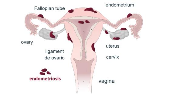 endometriosis endometriosis