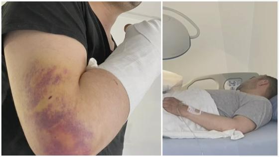 Policía pierde la mano por machetazo Policía pierde la mano por machetazo