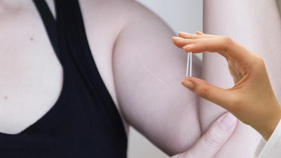 implante hormonal subdérmico implante hormonal subdérmico