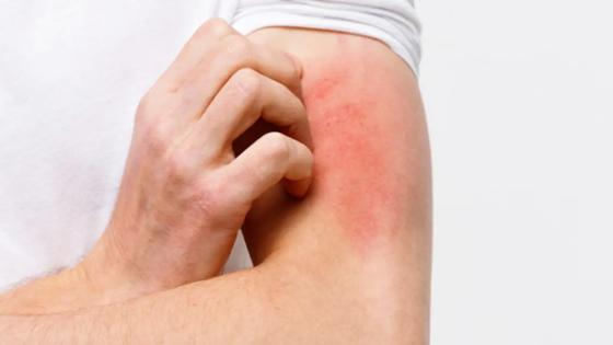 dermatitis dermatitis