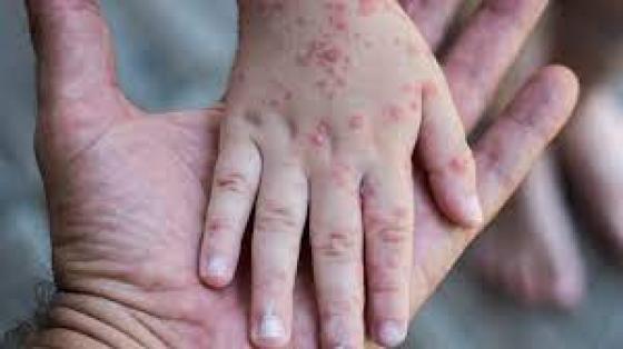 colombia-confirma-tres-casos-viruela-mono colombia-confirma-tres-casos-viruela-mono