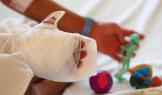 quemados polvora Antioquia noticias quemados polvora Antioquia noticias