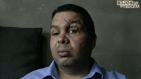 Víctimas de minas antipersona Víctimas de minas antipersona