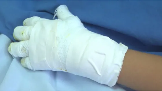 Seis lesionados con pólvora dejó la alborada en Antioquia Seis lesionados con pólvora dejó la alborada en Antioquia