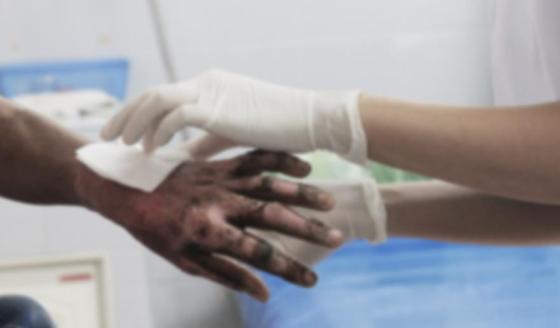 Tratar una quemadura navideña a tiempo puede evitar complicaciones. 