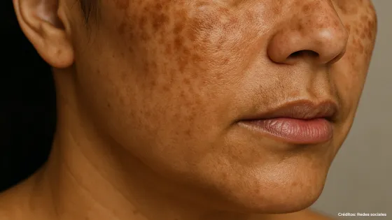 Melasma