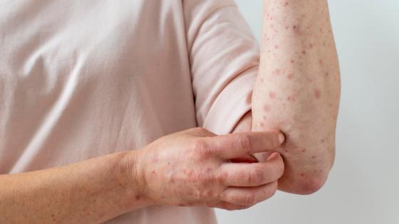 Imagen de referencia de sarampión.